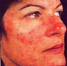 Acne Rosacea Cure