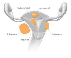 Fibroids