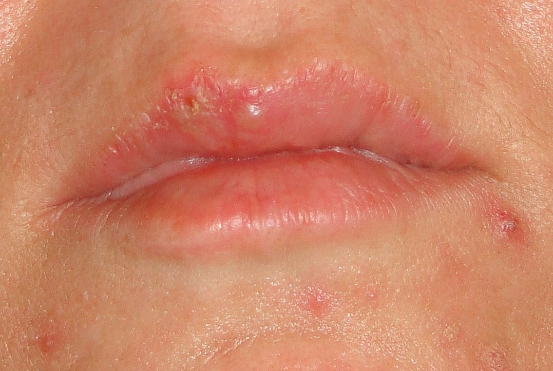 cold sores on lips pictures