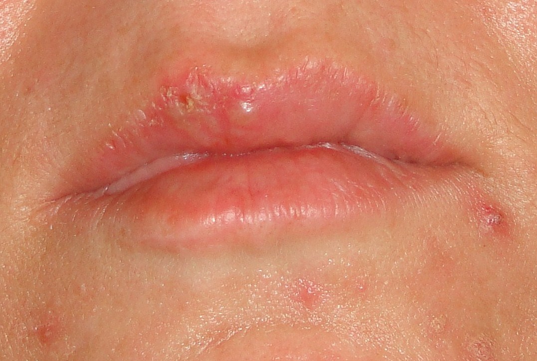 Herpes - oral: MedlinePlus Medical Encyclopedia