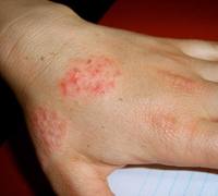 Eczema | Dermatitis | Atopic Dermatitis | MedlinePlus